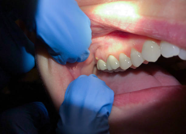 Best Emergency Wisdom Teeth Removal in Hoffman Estates, IL